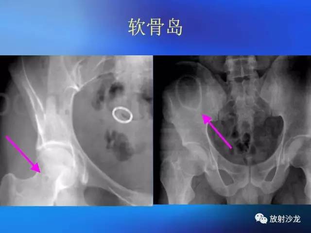 【PPT】骨、关节X线表现、正常变异