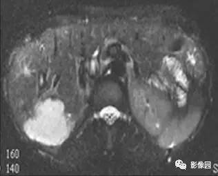 【病例】肝海绵状血管瘤1例MRI影像诊断分析 【病例】肝海绵状血管瘤1例MRI影像诊断分析