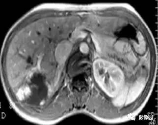 【病例】肝海绵状血管瘤1例MRI影像诊断分析