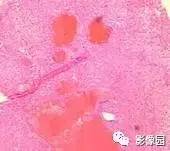【病例】肝海绵状血管瘤1例MRI影像诊断分析 【病例】肝海绵状血管瘤1例MRI影像诊断分析