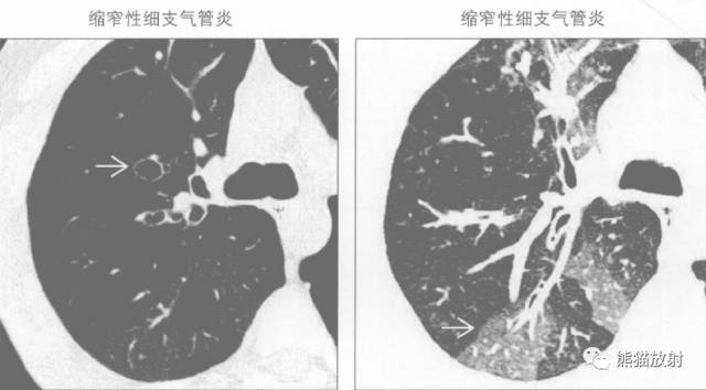 【书摘】“马赛克征”的鉴别诊断