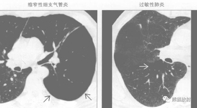 【书摘】“马赛克征”的鉴别诊断 【书摘】“马赛克征”的鉴别诊断