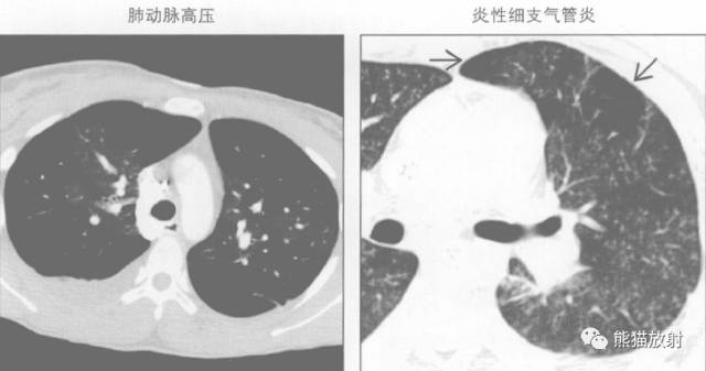【书摘】“马赛克征”的鉴别诊断 【书摘】“马赛克征”的鉴别诊断