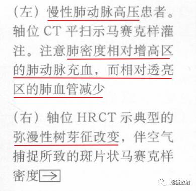 【书摘】“马赛克征”的鉴别诊断 【书摘】“马赛克征”的鉴别诊断