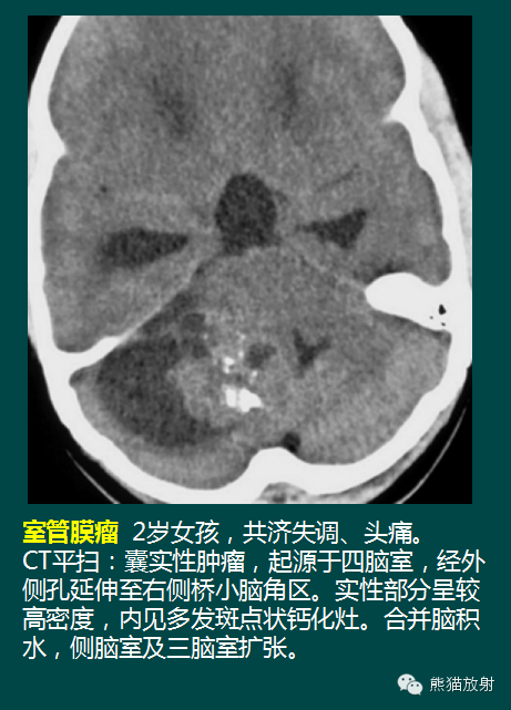 【PPT】脑室内肿瘤影像学表现 【PPT】脑室内肿瘤影像学表现