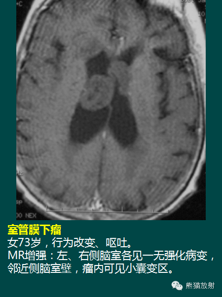【PPT】脑室内肿瘤影像学表现 【PPT】脑室内肿瘤影像学表现