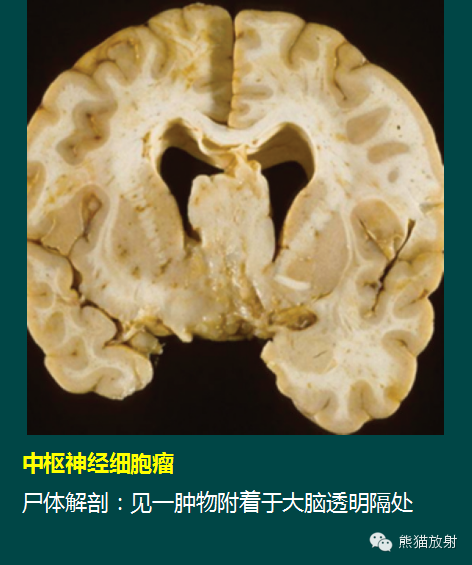 【PPT】脑室内肿瘤影像学表现 【PPT】脑室内肿瘤影像学表现