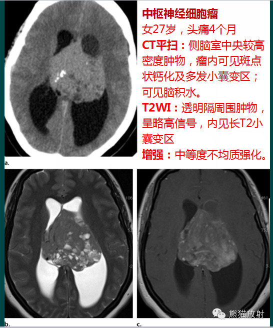 【PPT】脑室内肿瘤影像学表现 【PPT】脑室内肿瘤影像学表现