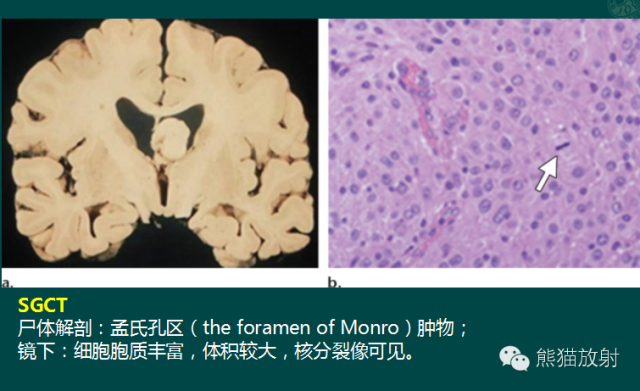 【PPT】脑室内肿瘤影像学表现 【PPT】脑室内肿瘤影像学表现