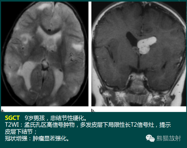 【PPT】脑室内肿瘤影像学表现 【PPT】脑室内肿瘤影像学表现