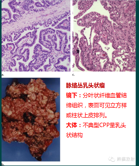 【PPT】脑室内肿瘤影像学表现 【PPT】脑室内肿瘤影像学表现