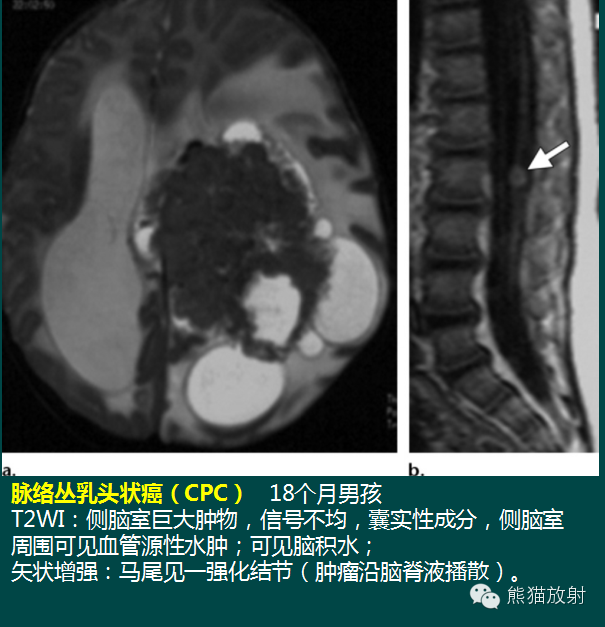 【PPT】脑室内肿瘤影像学表现 【PPT】脑室内肿瘤影像学表现