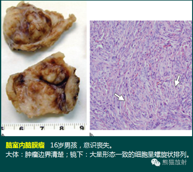 【PPT】脑室内肿瘤影像学表现 【PPT】脑室内肿瘤影像学表现