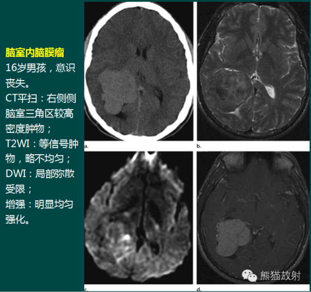【PPT】脑室内肿瘤影像学表现 【PPT】脑室内肿瘤影像学表现