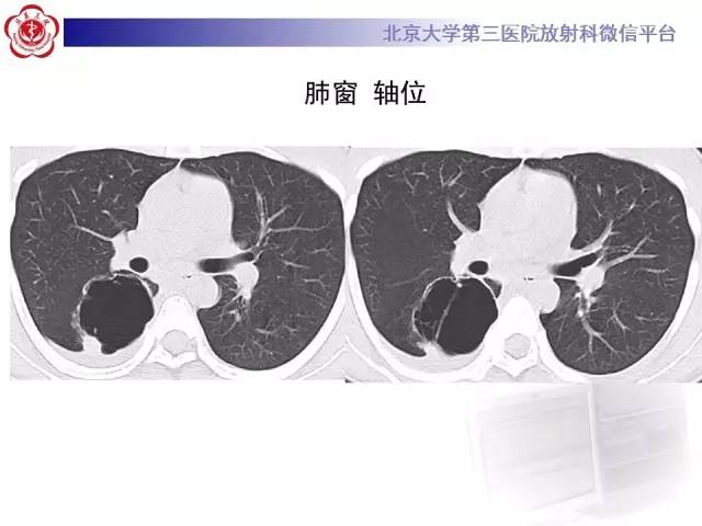【病例】囊腔类肺癌1例CT影像表现