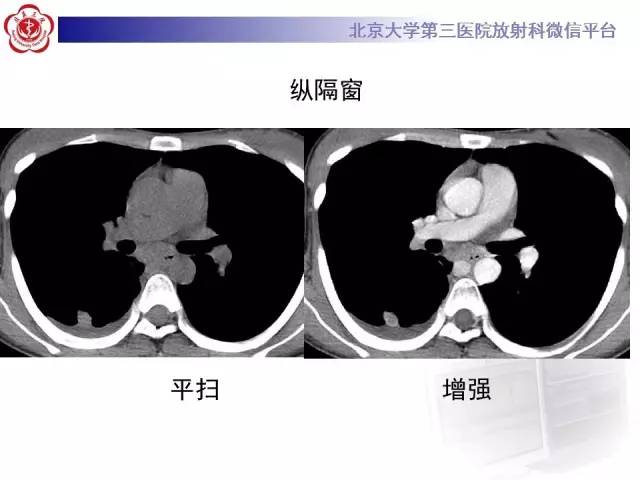 【病例】囊腔类肺癌1例CT影像表现