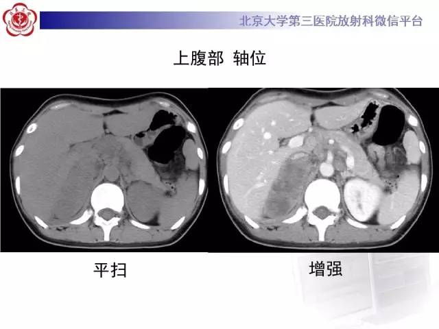 【病例】囊腔类肺癌1例CT影像表现