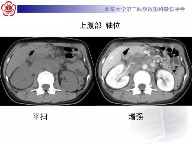 【病例】囊腔类肺癌1例CT影像表现