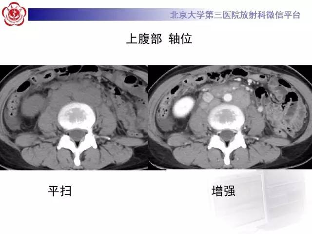 【病例】囊腔类肺癌1例CT影像表现