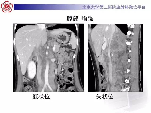 【病例】囊腔类肺癌1例CT影像表现