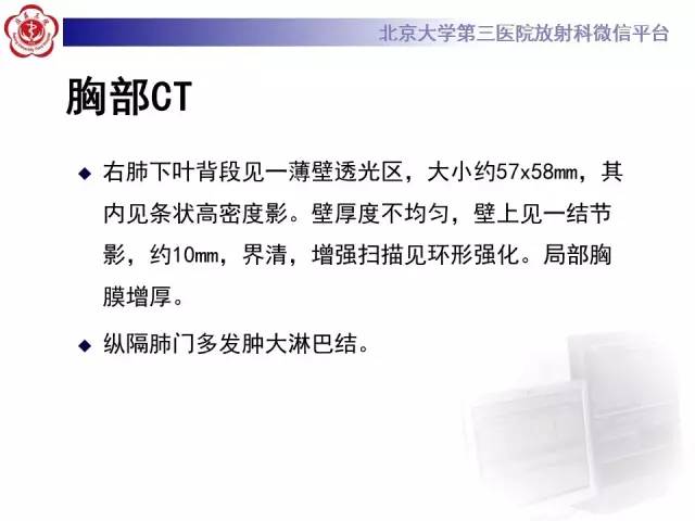 【病例】囊腔类肺癌1例CT影像表现