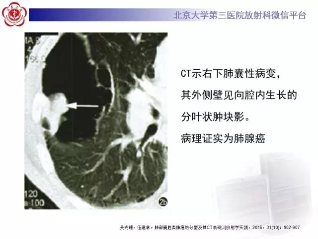 【病例】囊腔类肺癌1例CT影像表现