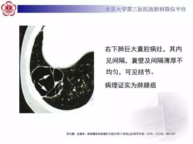 【病例】囊腔类肺癌1例CT影像表现