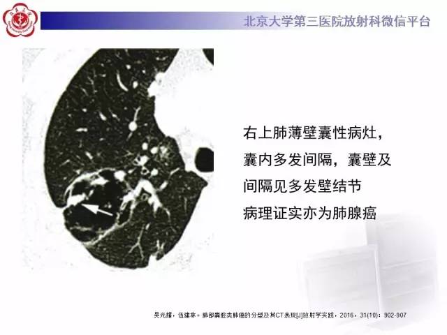 【病例】囊腔类肺癌1例CT影像表现