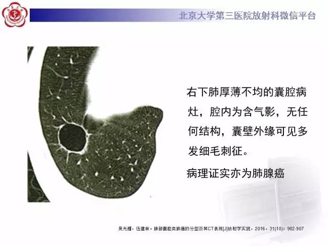 【病例】囊腔类肺癌1例CT影像表现