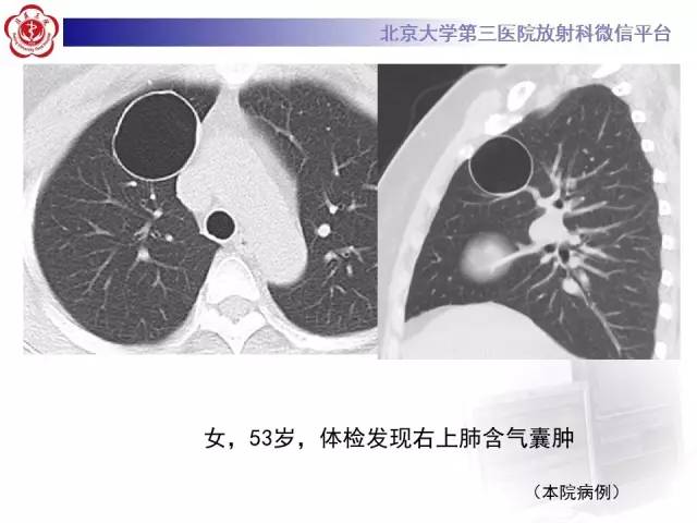 【病例】囊腔类肺癌1例CT影像表现