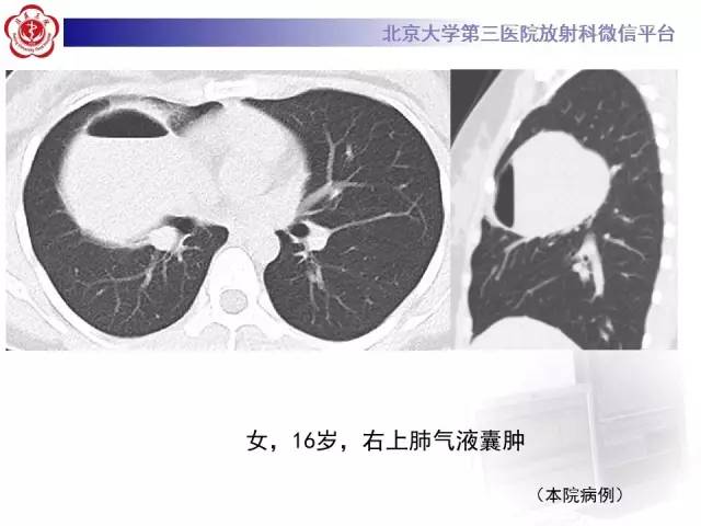 【病例】囊腔类肺癌1例CT影像表现