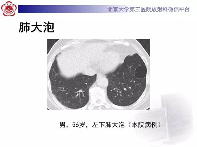 【病例】囊腔类肺癌1例CT影像表现