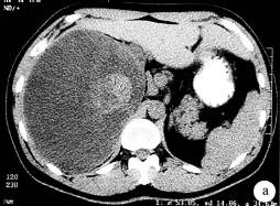【病例】肾乳头状腺癌1例CT影像表现分析