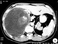 【病例】肾乳头状腺癌1例CT影像表现分析 【病例】肾乳头状腺癌1例CT影像表现分析