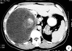 【病例】肾乳头状腺癌1例CT影像表现分析 【病例】肾乳头状腺癌1例CT影像表现分析