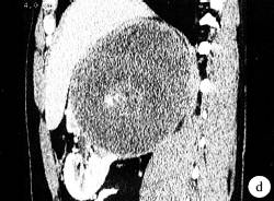 【病例】肾乳头状腺癌1例CT影像表现分析 【病例】肾乳头状腺癌1例CT影像表现分析