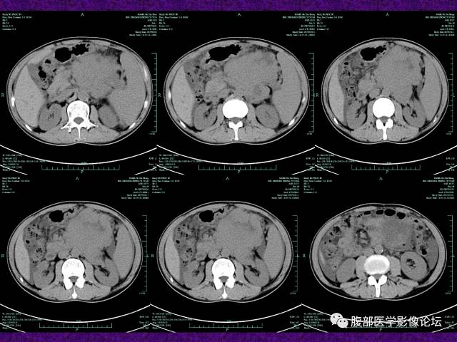 【病例】腹部外周恶性神经外胚叶肿瘤1例CT