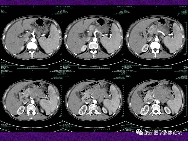 【病例】腹部外周恶性神经外胚叶肿瘤1例CT