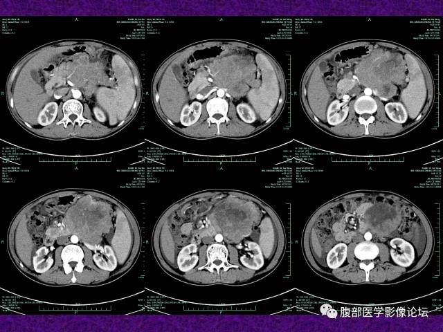 【病例】腹部外周恶性神经外胚叶肿瘤1例CT