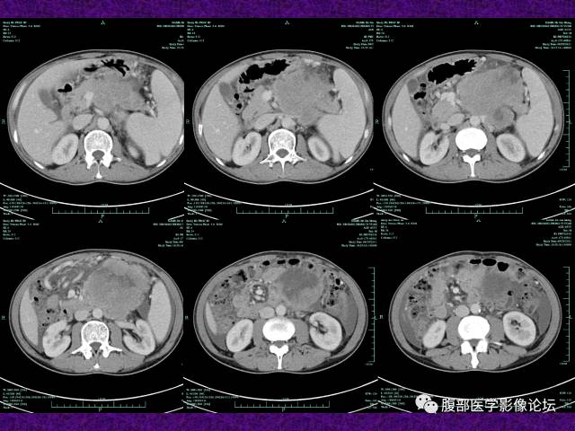 【病例】腹部外周恶性神经外胚叶肿瘤1例CT