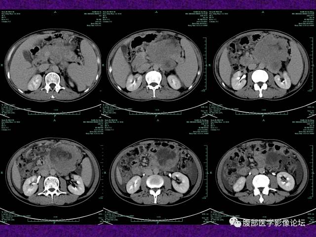 【病例】腹部外周恶性神经外胚叶肿瘤1例CT