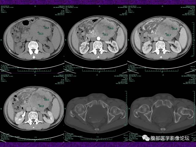 【病例】腹部外周恶性神经外胚叶肿瘤1例CT