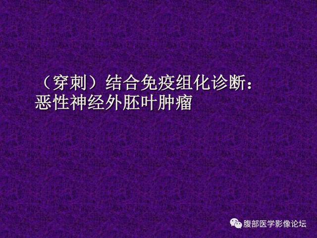 【病例】腹部外周恶性神经外胚叶肿瘤1例CT