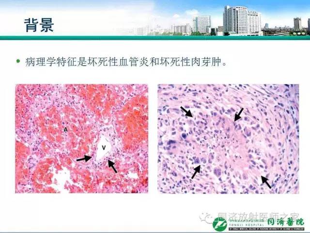 【PPT】肉芽肿性多发血管炎的胸部MSCT特征