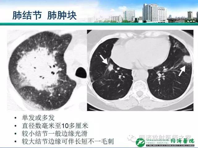 【PPT】肉芽肿性多发血管炎的胸部MSCT特征