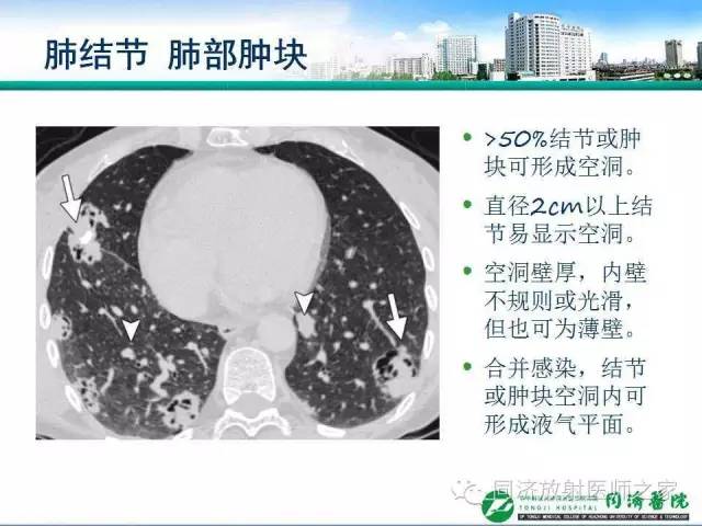 【PPT】肉芽肿性多发血管炎的胸部MSCT特征
