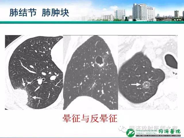 【PPT】肉芽肿性多发血管炎的胸部MSCT特征