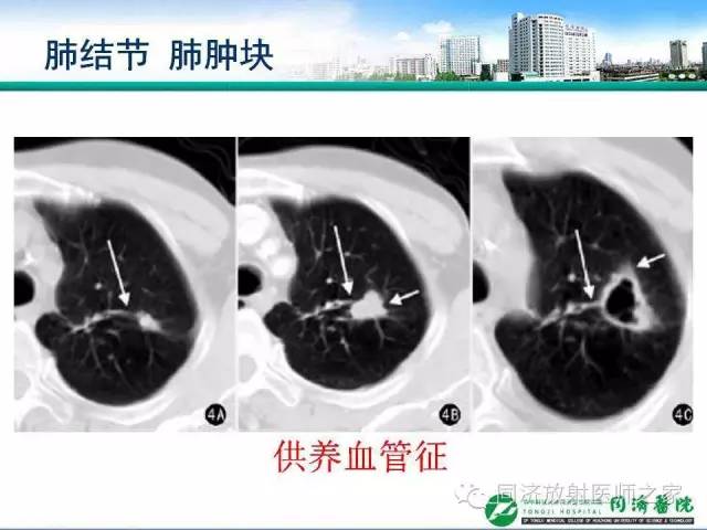 【PPT】肉芽肿性多发血管炎的胸部MSCT特征