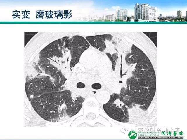【PPT】肉芽肿性多发血管炎的胸部MSCT特征