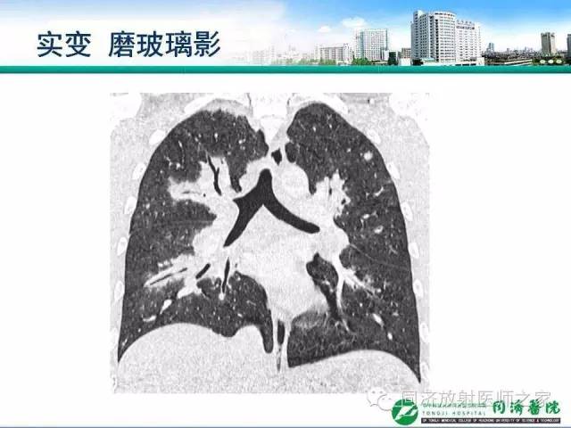 【PPT】肉芽肿性多发血管炎的胸部MSCT特征